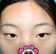济南美思慕割双眼皮怎么样？有近期案例吗？ width=