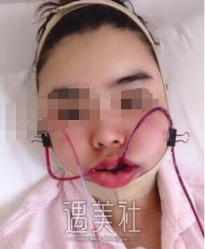 穆雄铮,磨骨