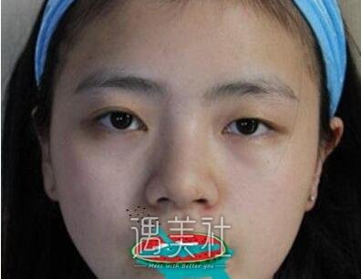 沈阳医大,黄威,双眼皮
