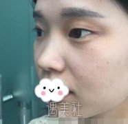 刘辅蓉双眼皮案例图：变美还得趁年轻 width=