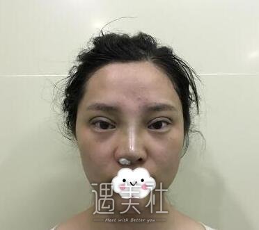 刘辅蓉,双眼皮