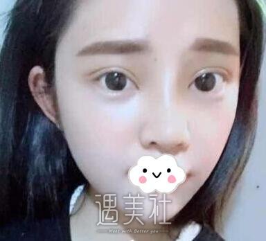 刘辅蓉,双眼皮
