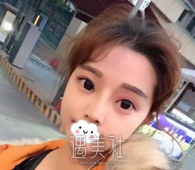 刘辅蓉,双眼皮