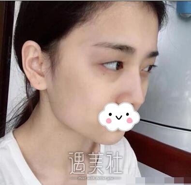 美莱,刘金华,双眼皮