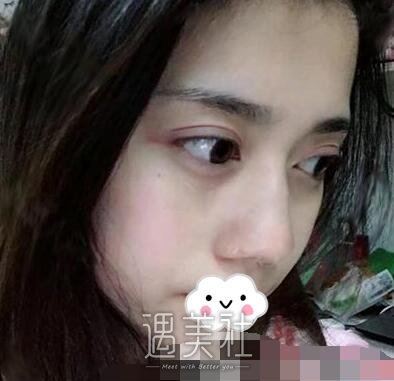 美莱,刘金华,双眼皮