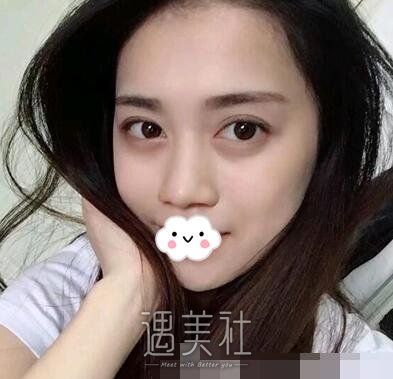 美莱,刘金华,双眼皮