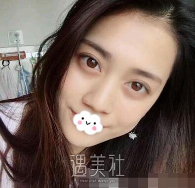 美莱,刘金华,双眼皮