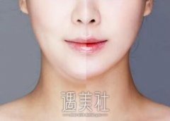 杭州做面部吸脂手术多少钱？价格贵不贵？ width=