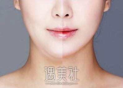 杭州,面部吸脂手术