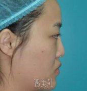 耳软骨隆鼻恢复过程图|耳软骨隆鼻真实记录~ width=