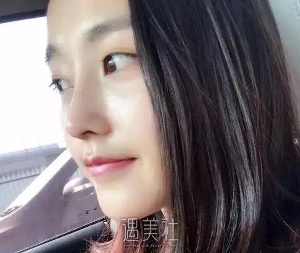 耳软骨隆鼻恢复过程图|耳软骨隆鼻真实记录~