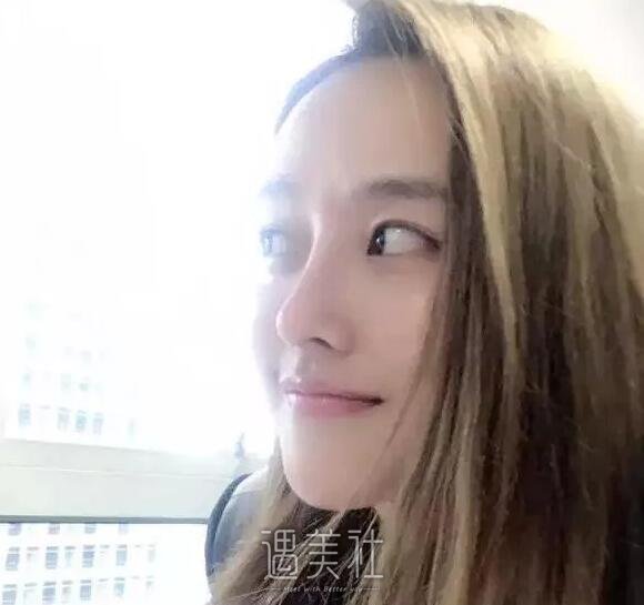 耳软骨隆鼻恢复过程图|耳软骨隆鼻真实记录~