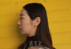 欧阳春鼻子案例：隆鼻找对医生很重要啊! width=