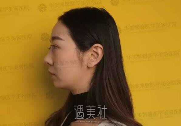 欧阳春鼻子案例：隆鼻找对医生很重要啊!