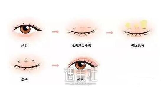 省立医院割双眼皮多少钱?比私立机构收费贵吗?
