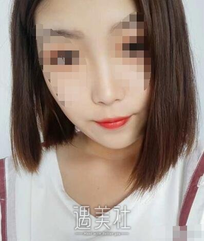 郴州维纳斯整形怎么样?有相关的隆鼻案例吗?
