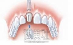成都种植牙价格表2020更新上线|种植牙多少钱？ width=