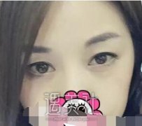 舒茂国双眼皮怎么样|舒茂国双眼皮案例来袭~ width=
