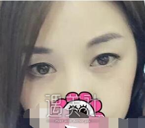 舒茂国,双眼皮