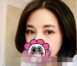 舒茂国,双眼皮