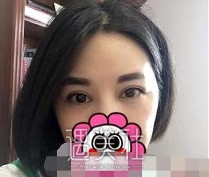 舒茂国,双眼皮