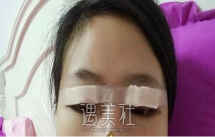 徐晓斐,双眼皮修复
