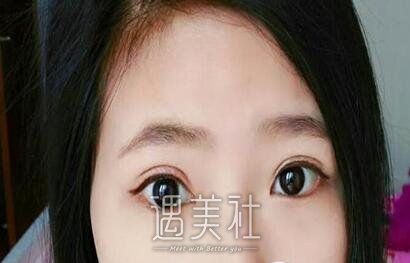徐晓斐,双眼皮修复