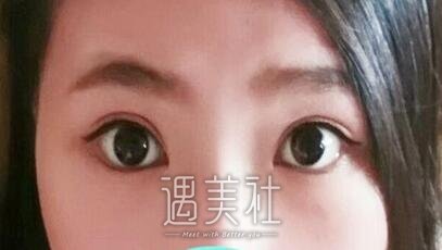 徐晓斐,双眼皮修复