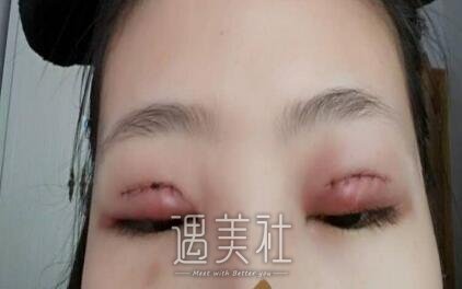 徐晓斐,双眼皮修复