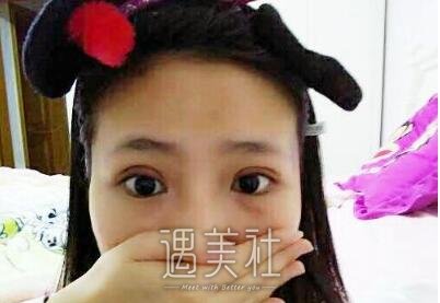 徐晓斐,双眼皮修复