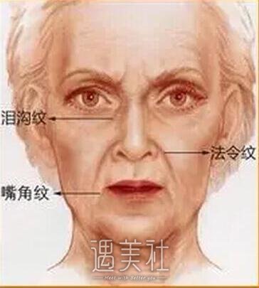 自体脂肪填充法令纹