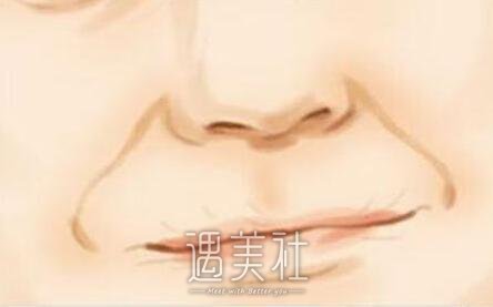 自体脂肪填充法令纹