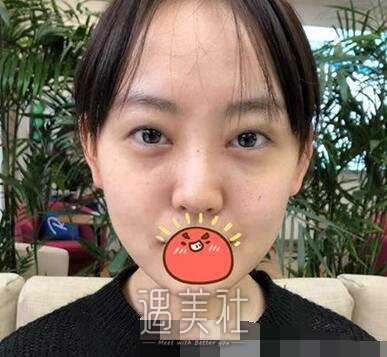 韩新鸣,双眼皮