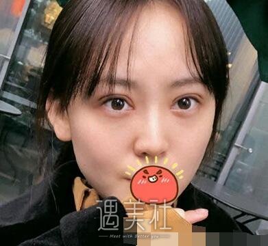 韩新鸣,双眼皮
