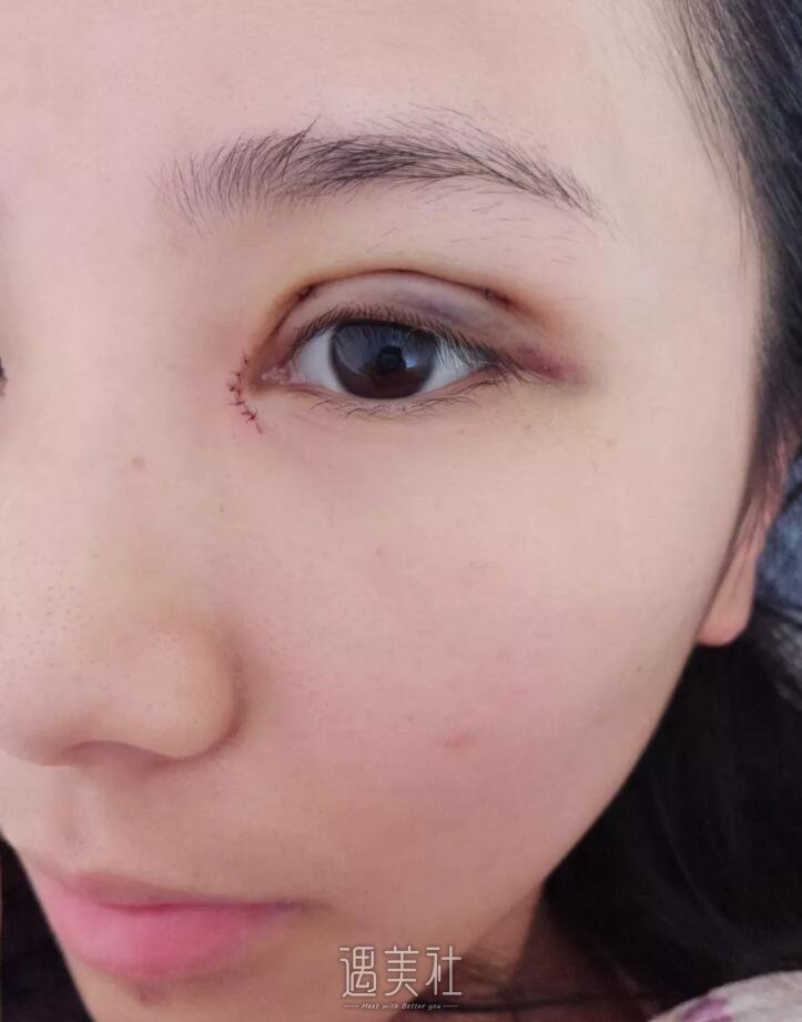 秦皇岛巧致医院怎么样?双眼皮案例及果图分享~