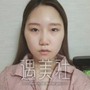 杭州维多利亚许凤芝案例：谢谢医生让我重拾自信! width=