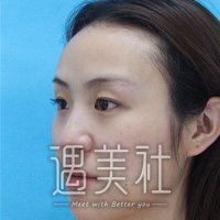天津坤如玛丽双眼皮怎么样?有案例给看下嘛?