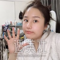 华西卿勇鼻部手术案例：鼻子立体了好看多了~