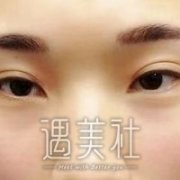 西安孙峰双眼皮案例：这果简直不要太棒! width=
