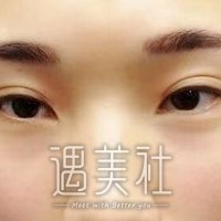 西安孙峰双眼皮案例：这果简直不要太棒!