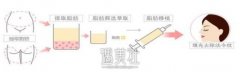 成都自体脂肪填充法令纹多少钱?怎么个收费标准? width=