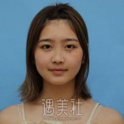 爱思特胡秀龙做鼻子案例：隆鼻让颜值提升几个level! width=