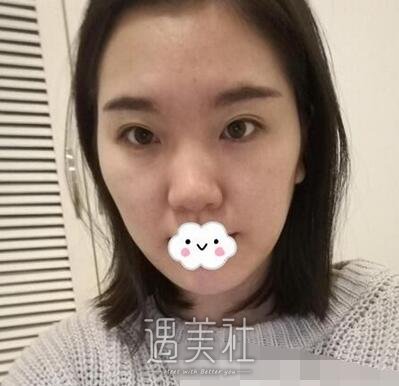 上海,张余光,双眼皮