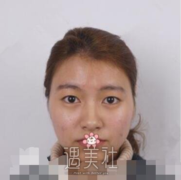 兰大二院,孙一岚,双眼皮