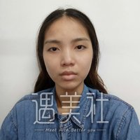 重庆西南医院整形科割双眼皮怎么样?真实案例展示~