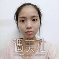重庆西南医院整形科割双眼皮怎么样?真实案例展示~