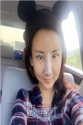 深圳恩吉娜双眼皮案例：是我喜欢的亚子!