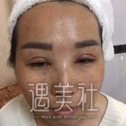老年斑去除前后对比图片分享——祛斑真实记录~ width=