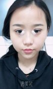 成都铜雀台整形医院价目表|双眼皮案例术后分享~ width=