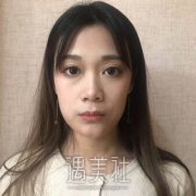 杭州珈禾整形医院价目表|假体隆鼻恢复过程分享~ width=